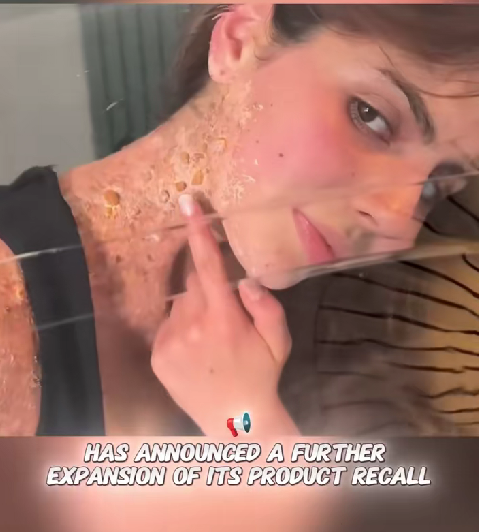 “Massive Product Recall Expands After Shocking Skin Reactions Go Viral — Consumers Warned to Check Their Shelves Immediately”