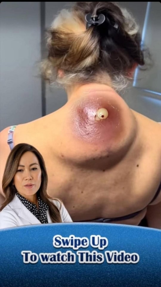 Massive Cyst on Woman’s Neck Shocks Viewers After Clip Goes Viral