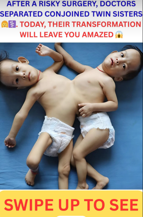 After a complex and risky operation doctors managed to separate these conjoined twin sisters
