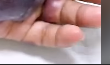 Blackened Hand Shows Dangers of Untreated Infections!